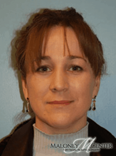 After Image: Rhinoplasty - front