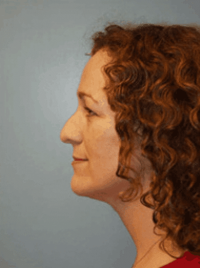 Before Image: Rhinoplasty - left-side