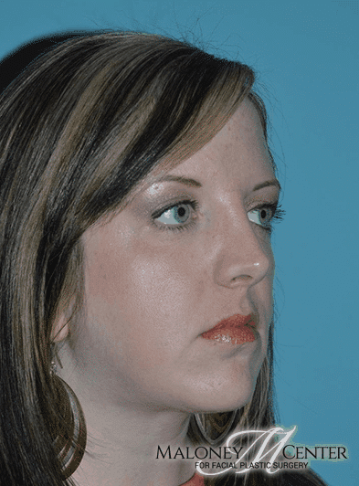After Image: Rhinoplasty - right-front-oblique