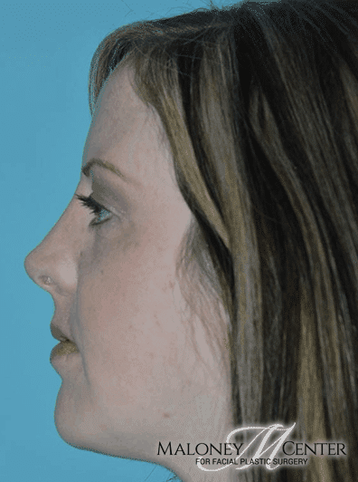 After Image: Rhinoplasty - left-side