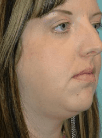 Before Image: Rhinoplasty - right-front-oblique