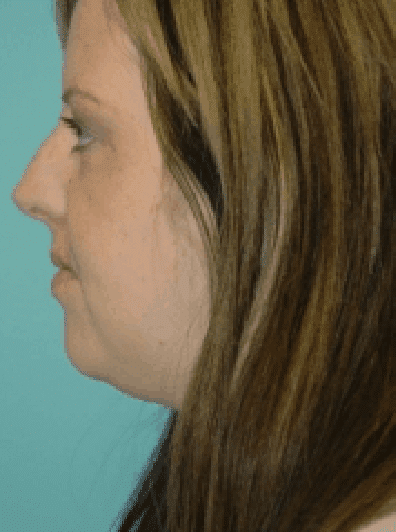 Before Image: Rhinoplasty - left-side