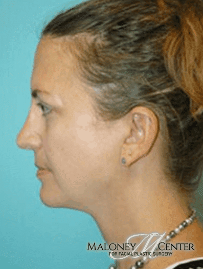 After Image: Rhinoplasty - left-side