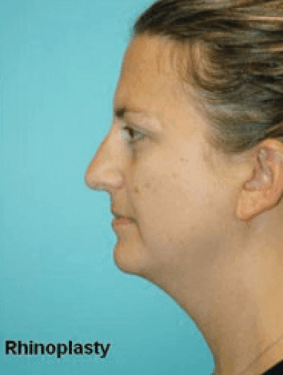 Before Image: Rhinoplasty - left-side
