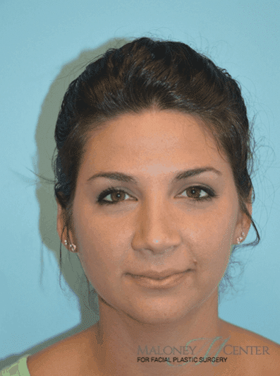After Image: Rhinoplasty - front