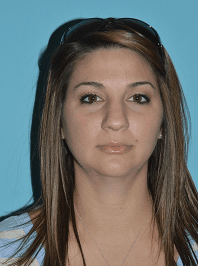 Before Image: Rhinoplasty - front