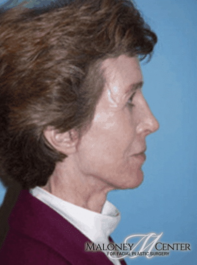 After Image: Rhinoplasty - right-side