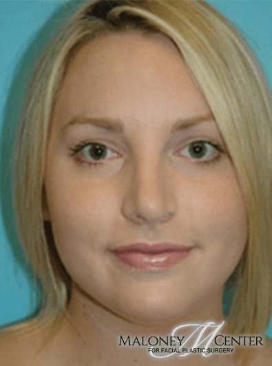After Image: Rhinoplasty - front