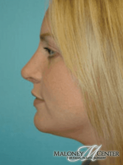 After Image: Rhinoplasty - left-side
