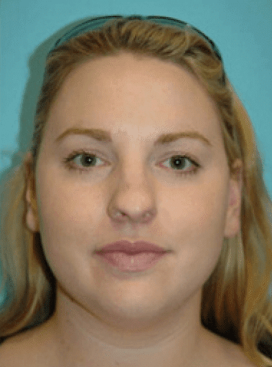Before Image: Rhinoplasty - front