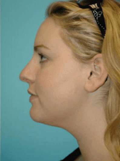 Before Image: Rhinoplasty - left-side