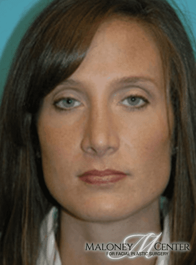 After Image: Rhinoplasty - front