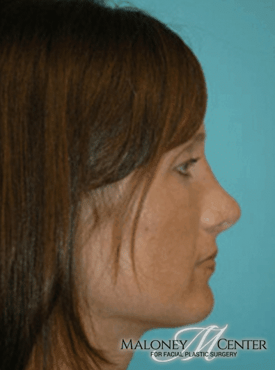 After Image: Rhinoplasty - right-side