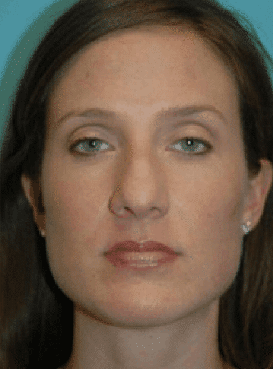 Before Image: Rhinoplasty - front
