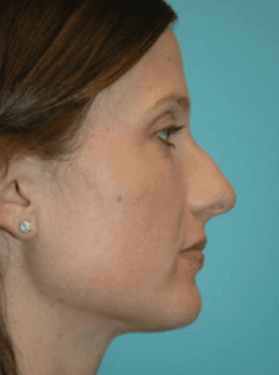 Before Image: Rhinoplasty - right-side