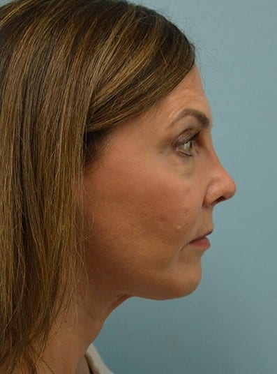 After Image: Rhinoplasty - right-side