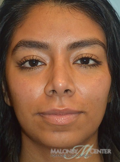 After Image: Rhinoplasty - front