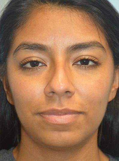 Before Image: Rhinoplasty - front
