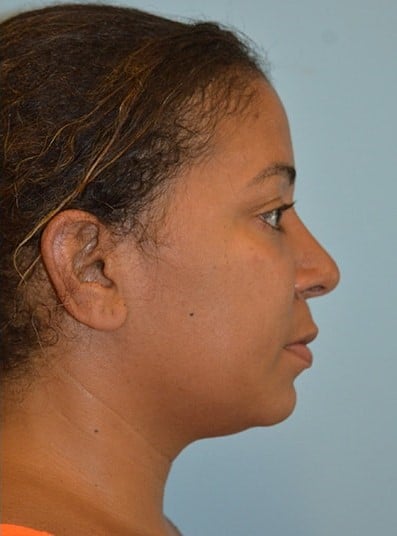 After Image: Rhinoplasty - right-side