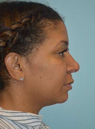 Before Image: Rhinoplasty - right-side
