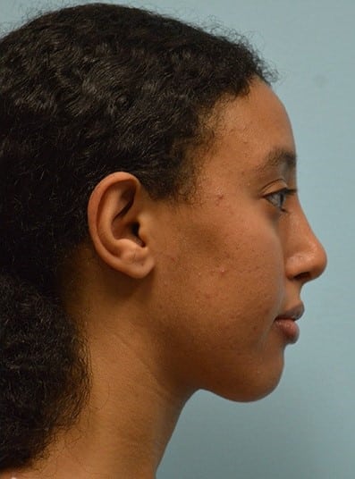 After Image: Rhinoplasty - right-side