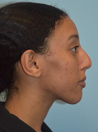 Before Image: Rhinoplasty - right-side