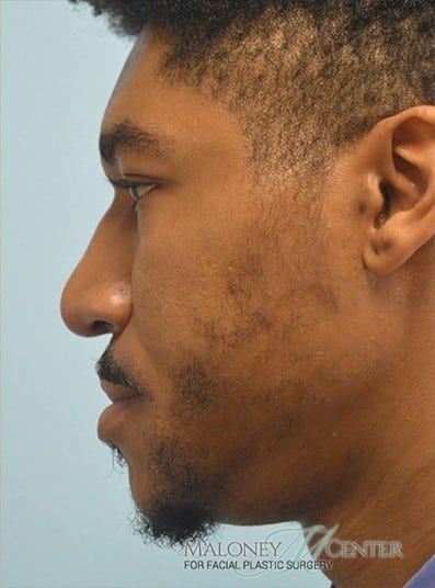 After Image: Rhinoplasty - left-side