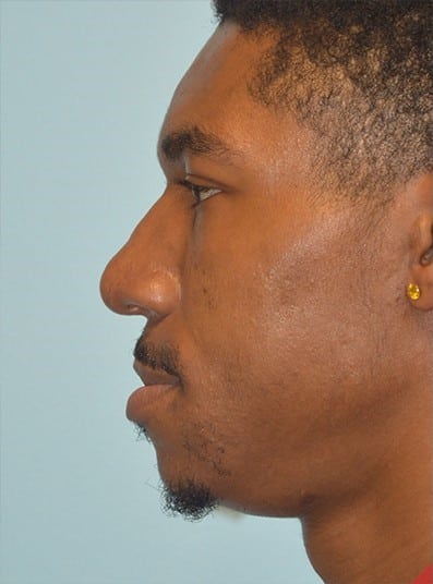 Before Image: Rhinoplasty - left-side