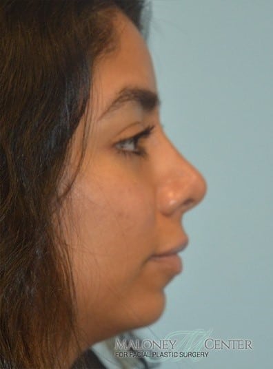 After Image: Rhinoplasty - right-side