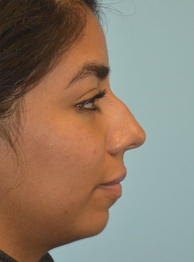 Before Image: Rhinoplasty - right-side