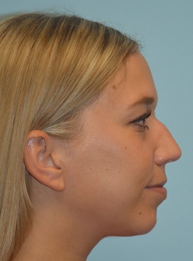 Before Image: Rhinoplasty - right-side