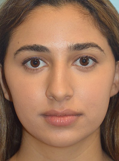 After Image: Rhinoplasty - front