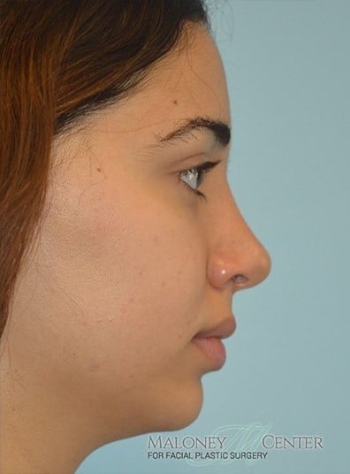 After Image: Rhinoplasty - right-side