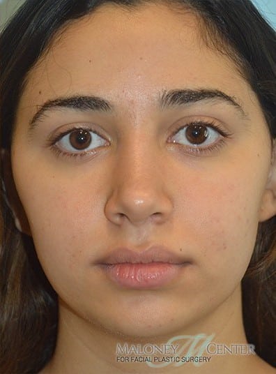 Before Image: Rhinoplasty - front