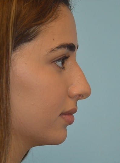 Before Image: Rhinoplasty - right-side