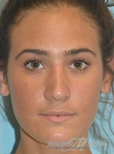 After Image: Rhinoplasty - front