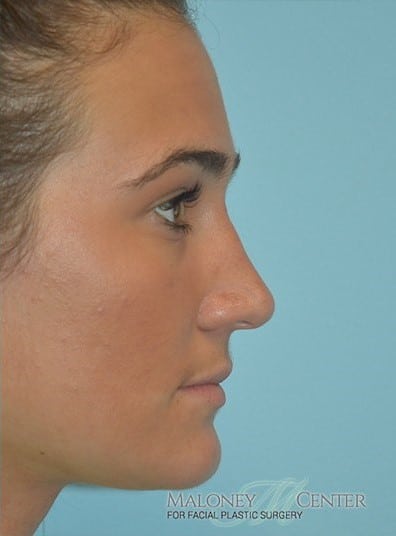 After Image: Rhinoplasty - right-side