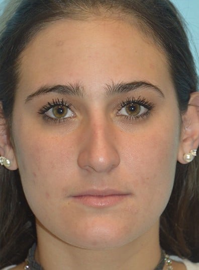 Before Image: Rhinoplasty - front
