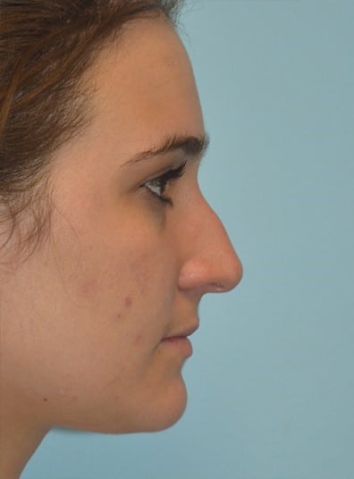 Before Image: Rhinoplasty - right-side
