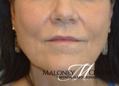 After Image: Sculptra - front