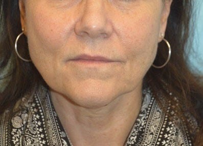 Before Image: Sculptra - front
