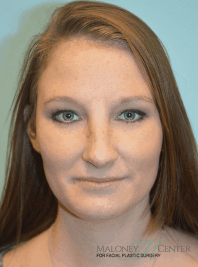 After Image: Teenage Rhinoplasty - front