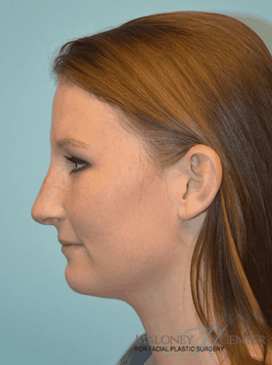 After Image: Teenage Rhinoplasty - left-side