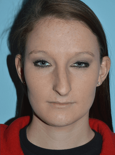 Before Image: Teenage Rhinoplasty - front