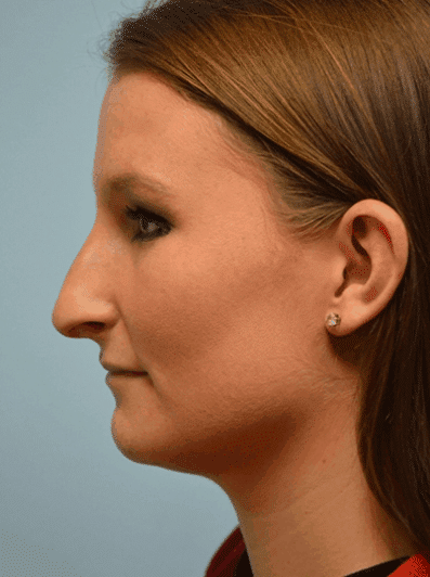Before Image: Teenage Rhinoplasty - left-side