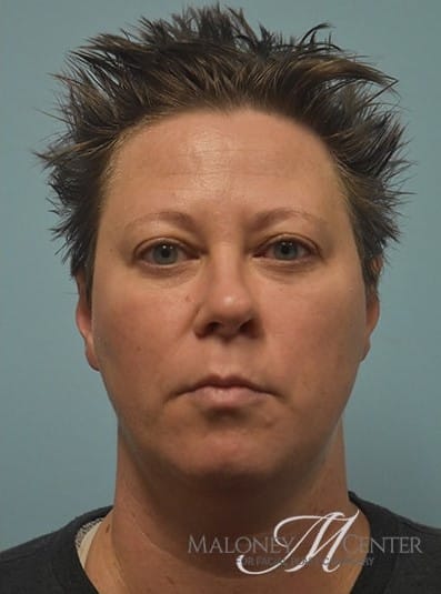 After Image: Under Eye (Tear Trough) Filler - front