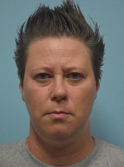 Before Image: Under Eye (Tear Trough) Filler - front