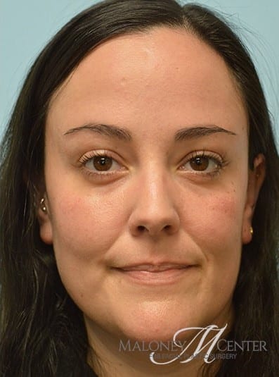 After Image: Under Eye (Tear Trough) Filler - front