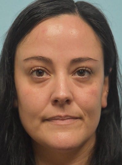 Before Image: Under Eye (Tear Trough) Filler - front