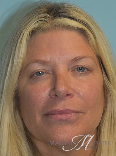 After Image: Under Eye (Tear Trough) Filler - front